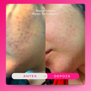 Rosa Selvagem Ácido - tira manchas na pele e elimina foliculite 8x mais rápido